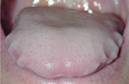 Langue dentelée suite à mauvaise position dans la bouche. Dyspraxie linguale.