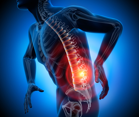 Lombalgie et syndrome de déficience posturale